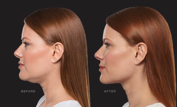 Kybella Double Chin