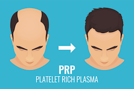 PRP for Hair Loss