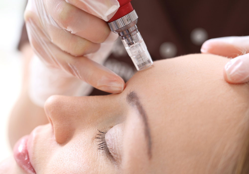 microneedling with prp northern virginia