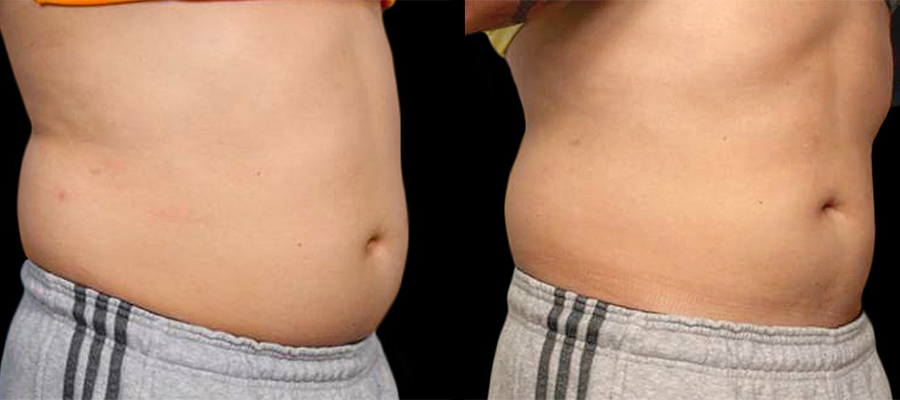 Non-Surgical Fat Removal Review - Vanquish Liposuction Results