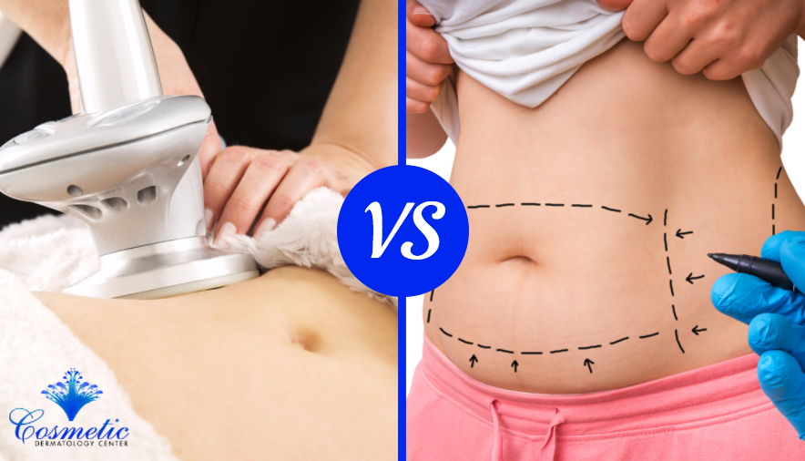 How to Choose Between Liposuction and Noninvasive Fat Reduction