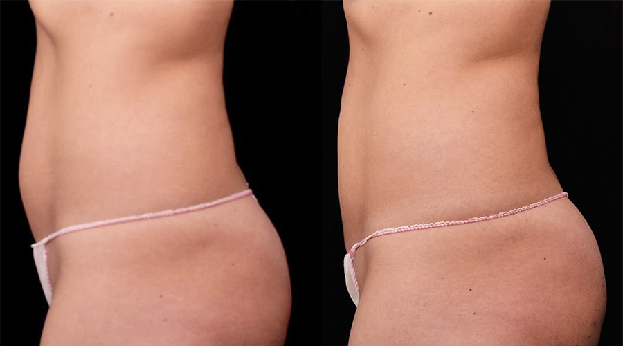 non invasive fat removal virginia