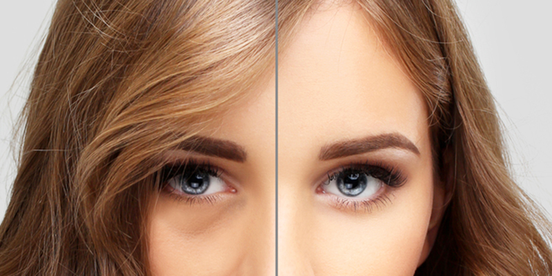 Dermal Fillers: A Great Way to Quickly Relieve Dark Circles - Cosmetic