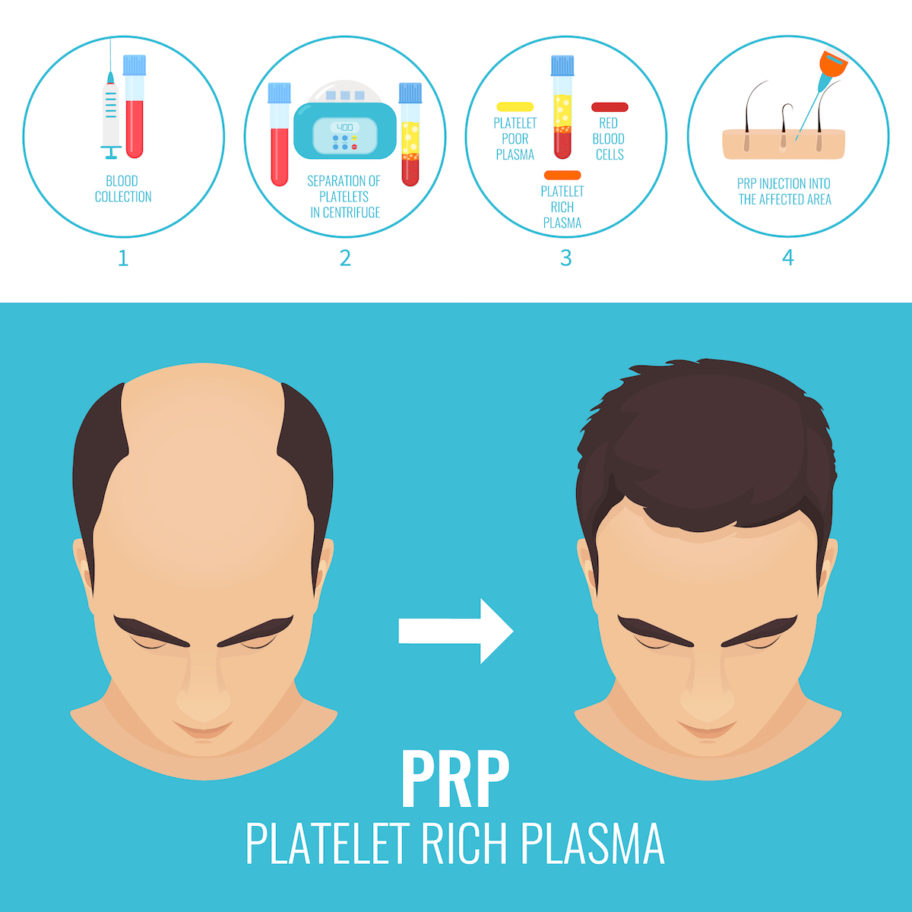 PRP for Hairloss