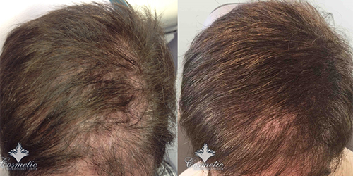 PRP Before and After McLean