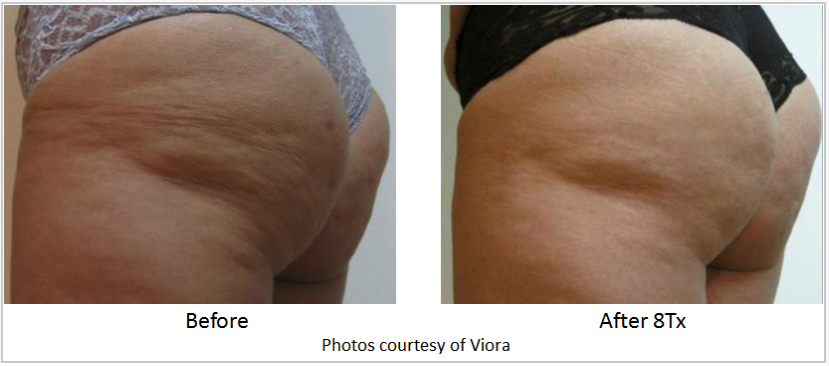 cellulite treatment virginia