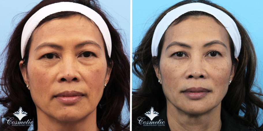 The Advantages of a Thread Lift in Northern Virginia - Cosmetic ...