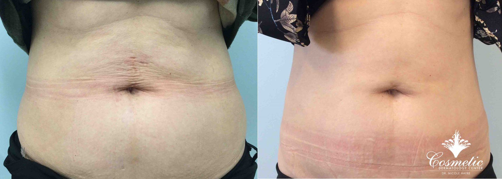 Tummy Skin Tightening - Nuceria Health, Miami, FL