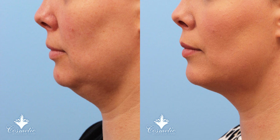 Kybella: On (and Off-Label) Ways to Eliminate Unwanted Fat - Cosmetic ...