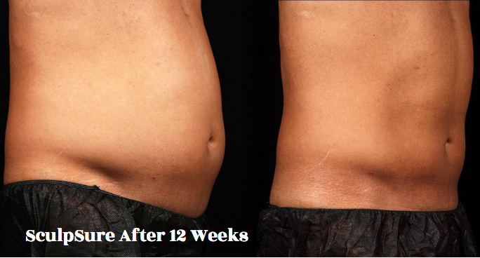 nonsurgical lipo northern virginia