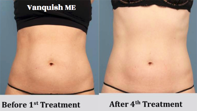 nonsugical liposuction virginia