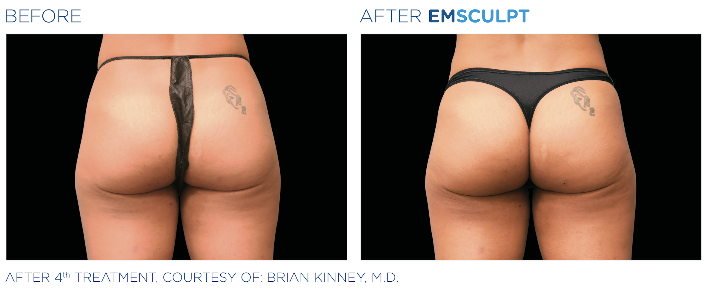 emsculpt butt lift northern virginia