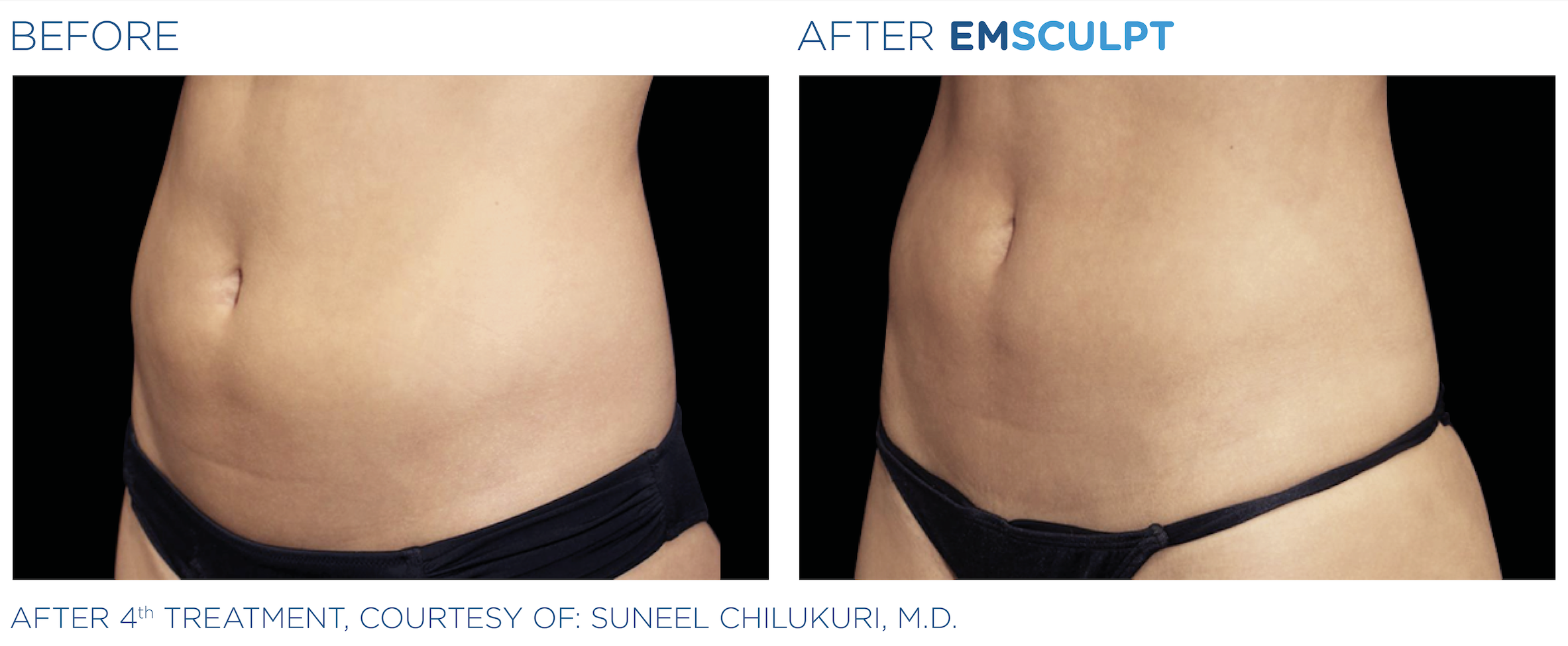 Sick of Back Pain?, Emsculpt in McLean Can Help