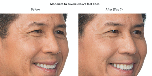 botox crows feet northern virginia