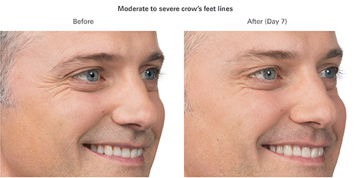 botox for men mclean