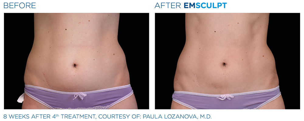 How does EMSCULPT help with diastasis recti? - Dermoperfection