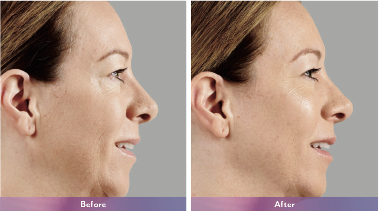 dermal fillers northern virginia