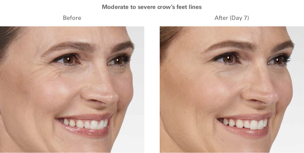 botox management mclean