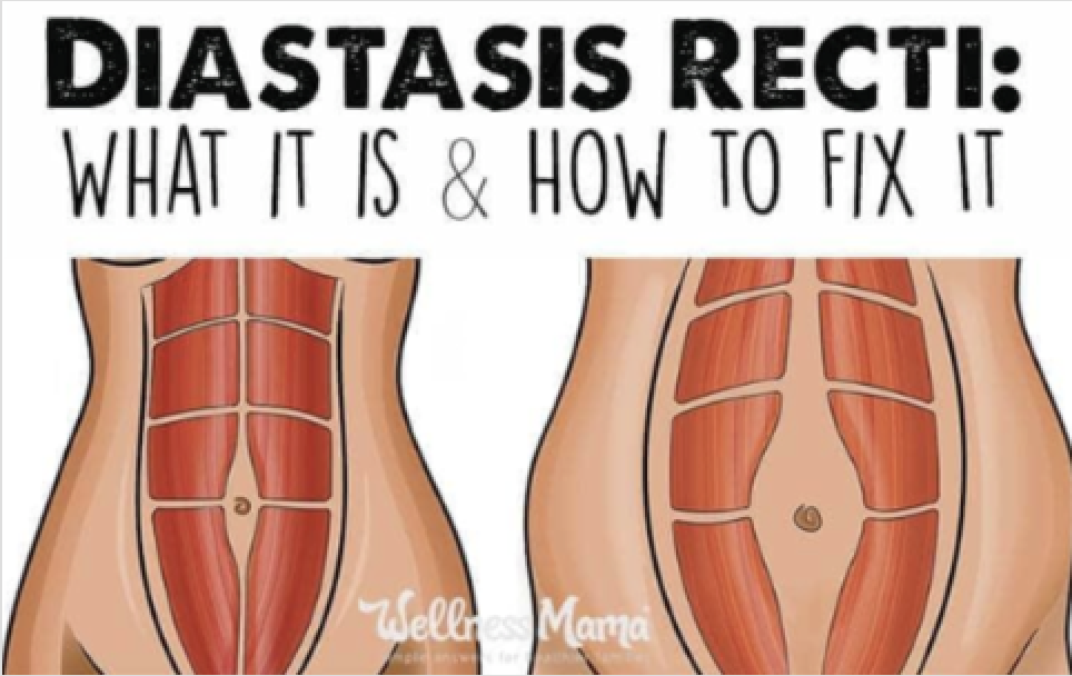 emsculpt diastasis recti mclean