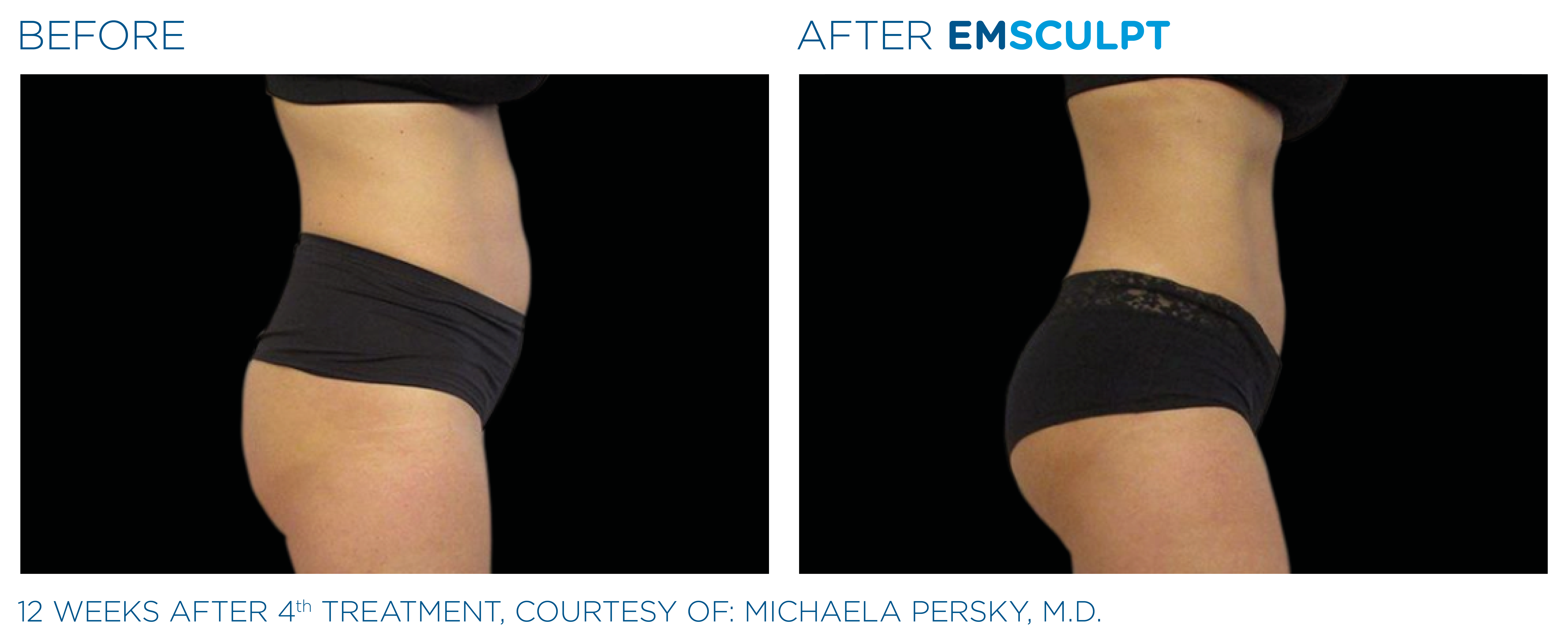 Butt Lift Alternative Emsculpt Mclean Cosmetic Dermatology Center 0801