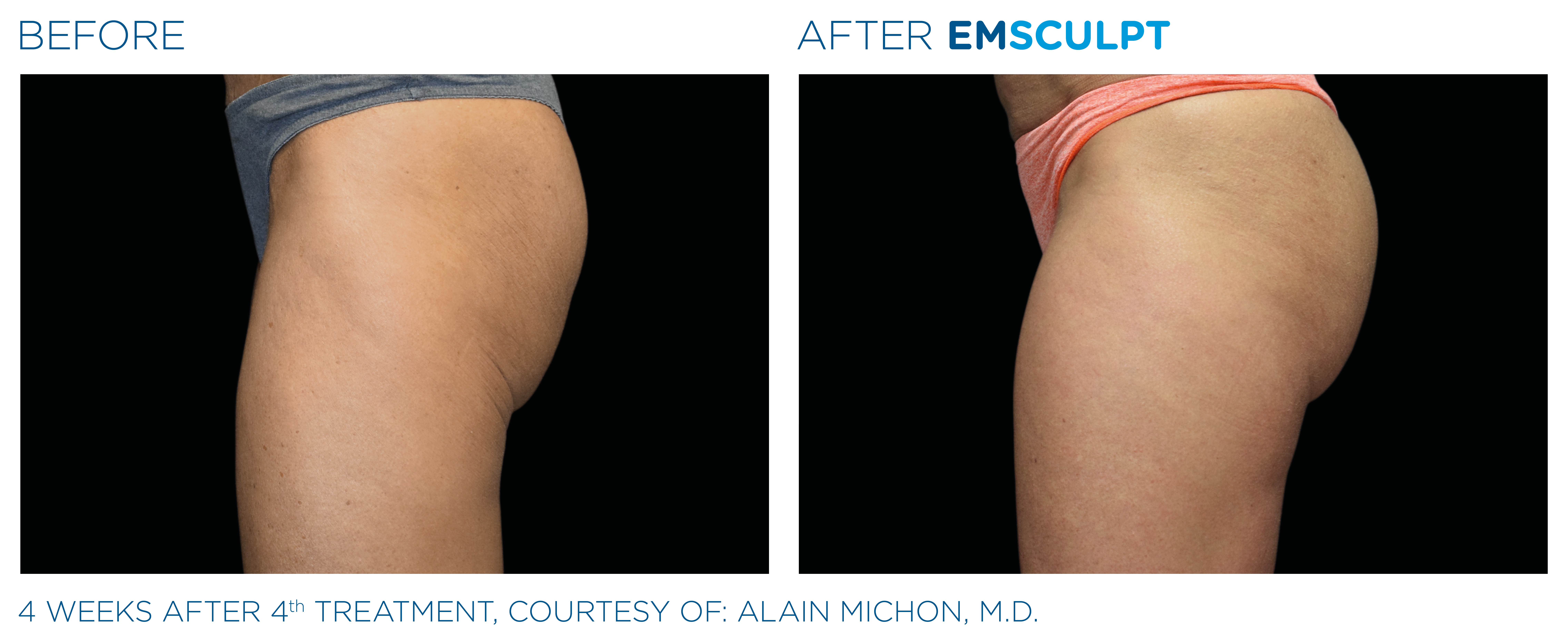 emsculpt northern virginia