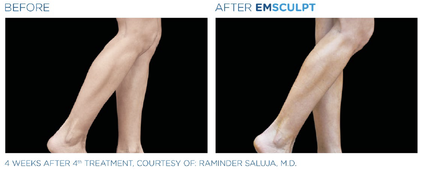 emsculpt legs northern virginia