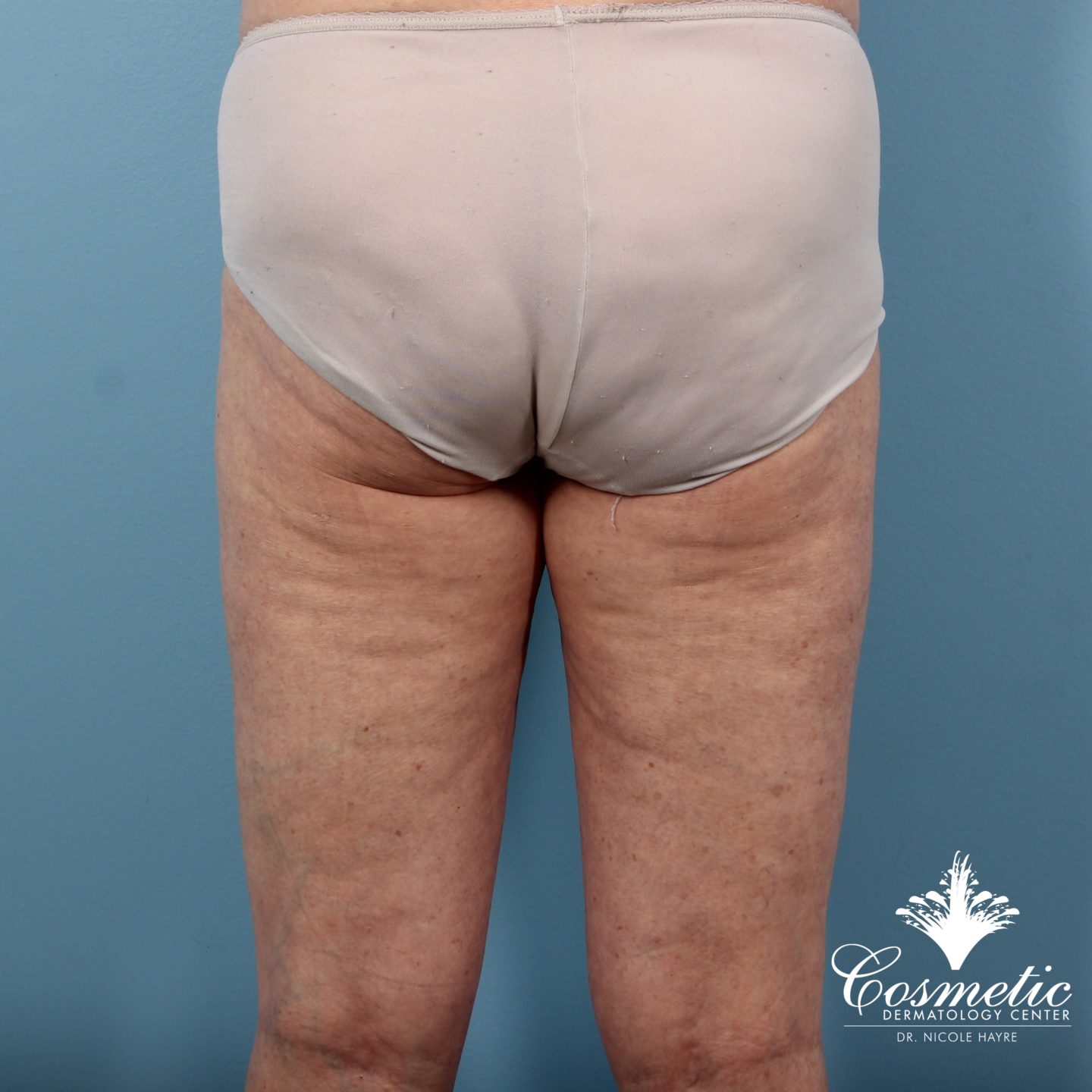 EmTone™ Cellulite Treatment - Cosmetic Dermatology Center