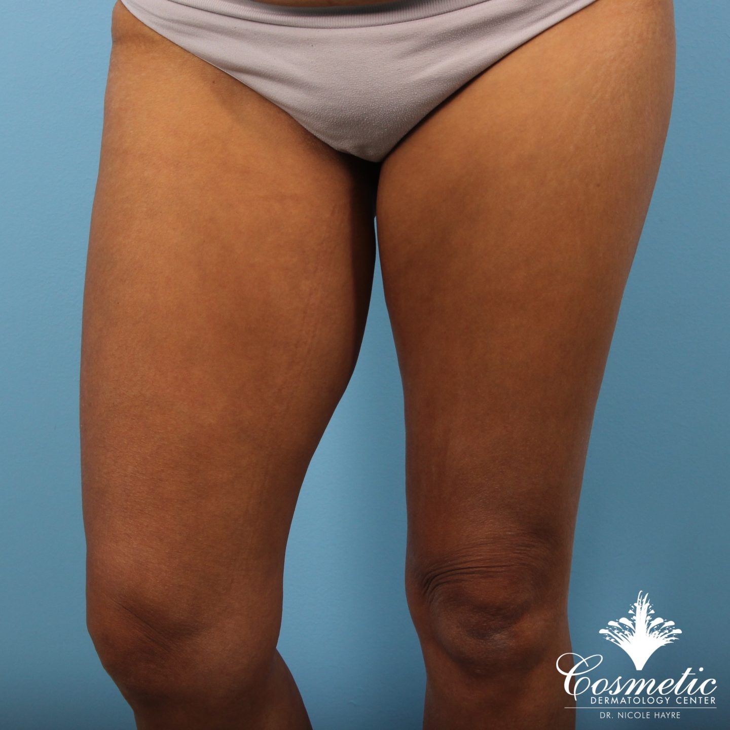 Emtone treats all 5 causes of cellulite