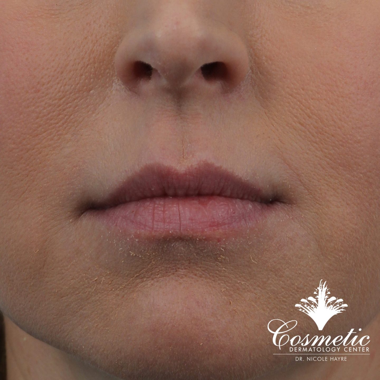 lip fillers falls church