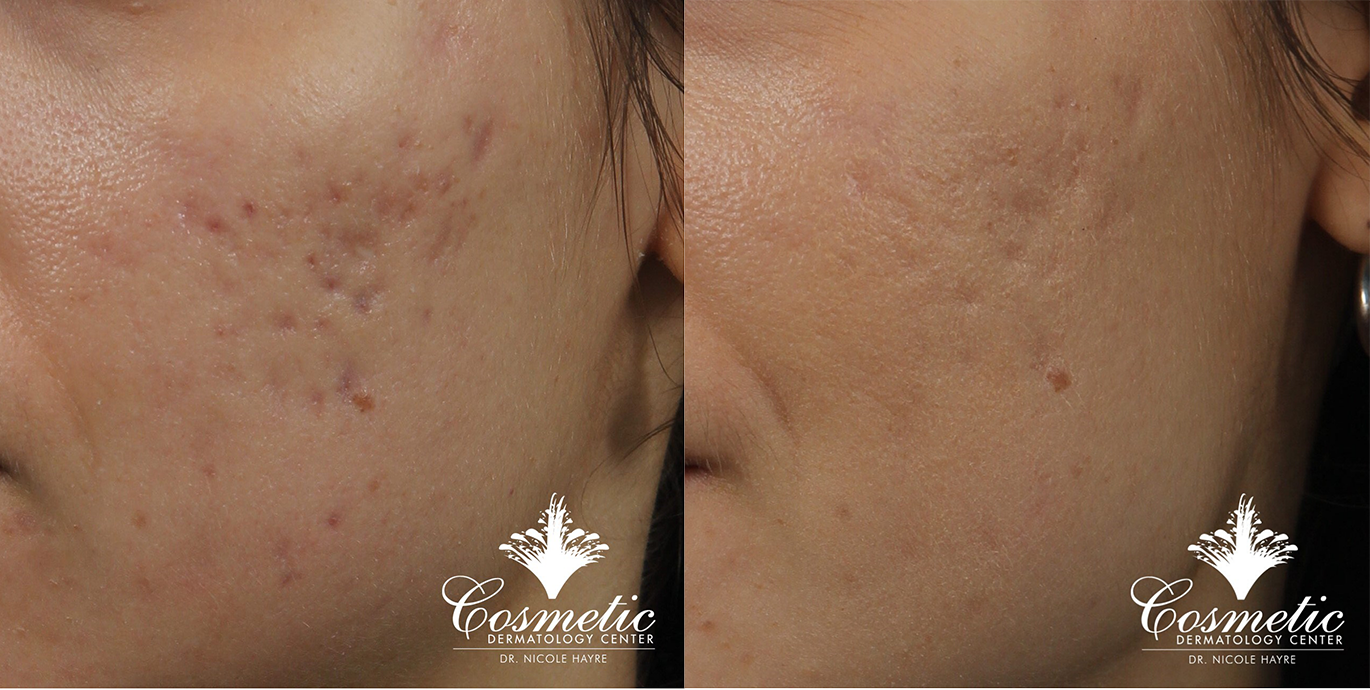 acne scars microneedling mclean