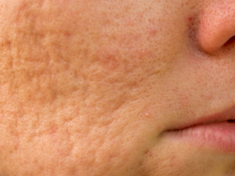 ipl or microneedling for acne scars