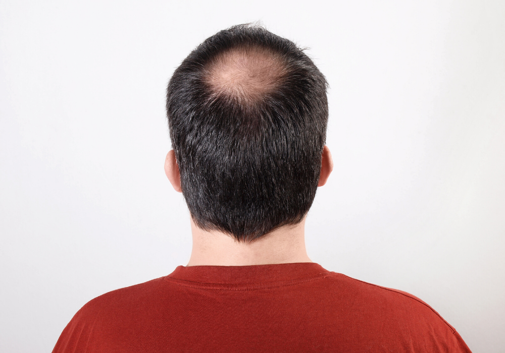 is PRP therapy for hair loss painful