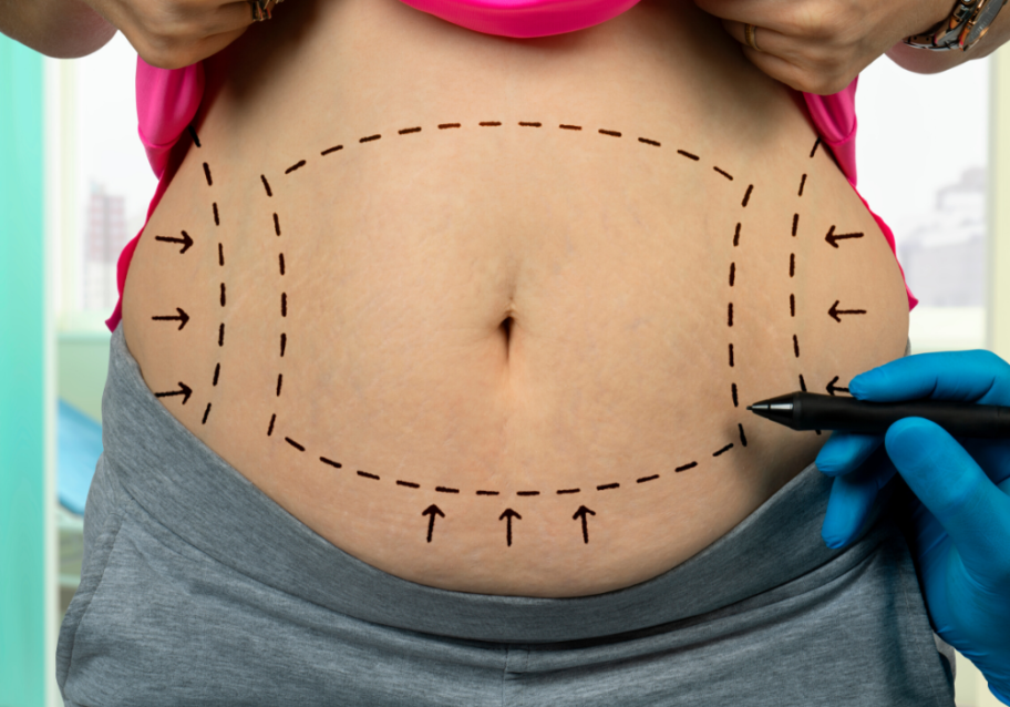 noninvasive liposuction in northern virginia