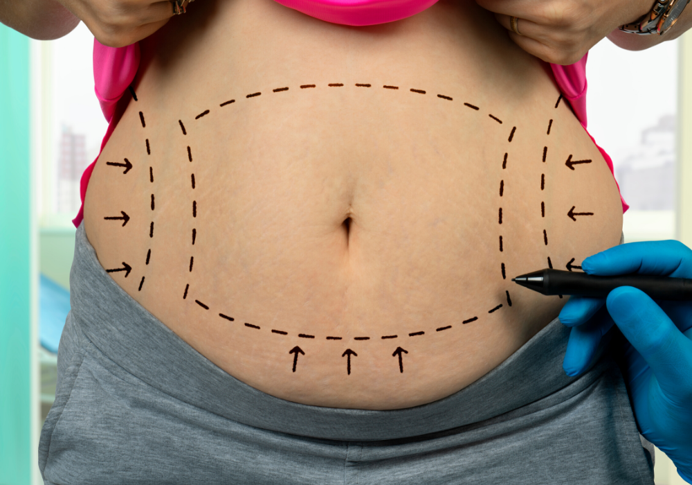 noninvasive liposuction in northern virginia