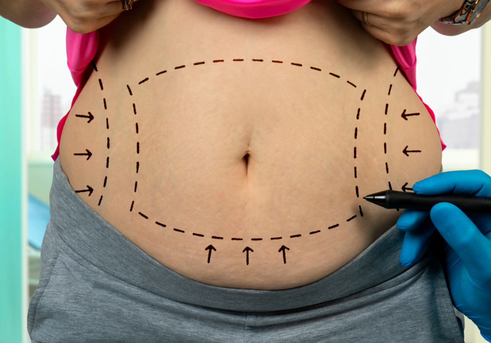 Non-Invasive Liposuction, freezing fat cells, Stomach Liposuction before  and after