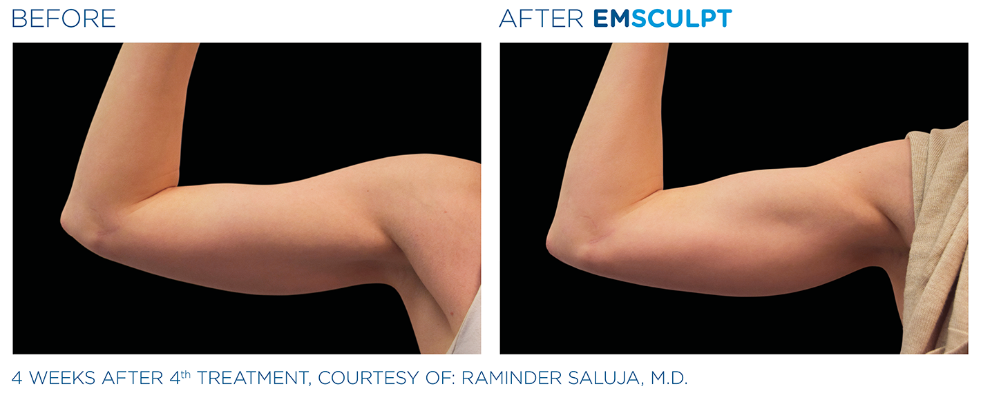 tone your arms with emsculpt in mclean virginia