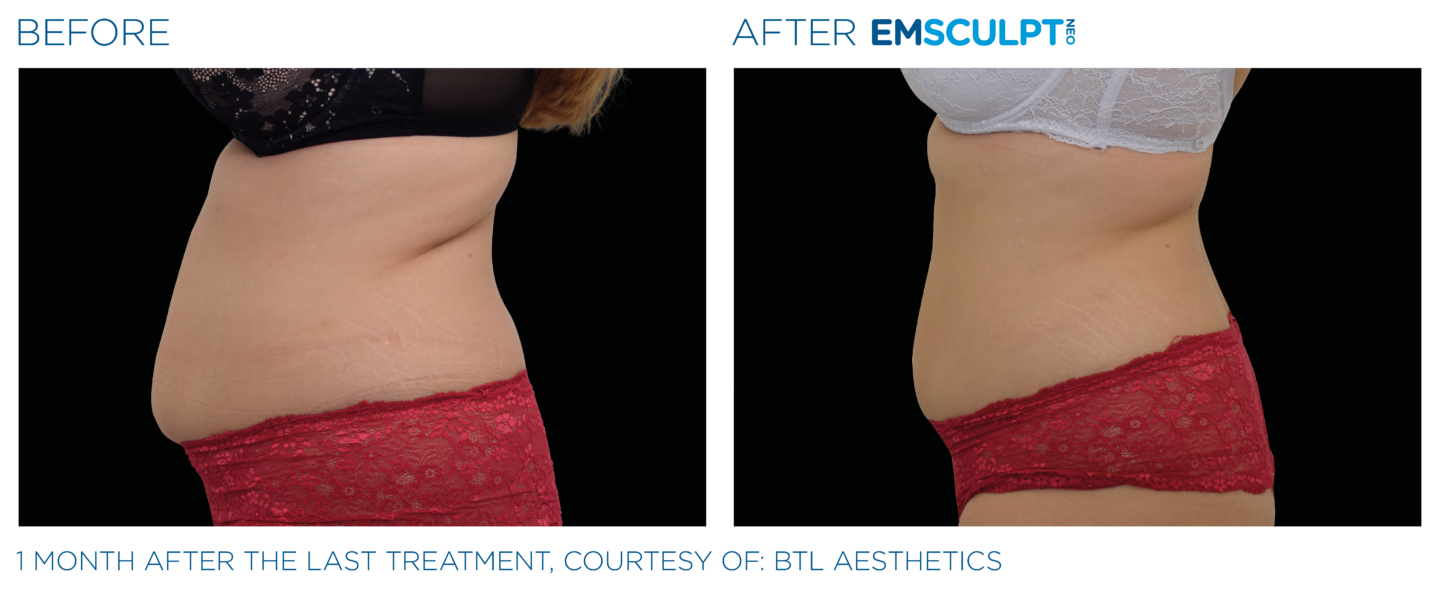 emsculpt neo in northern virginia