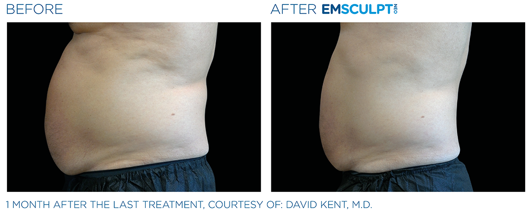 emsculpt neo results in northern virginia