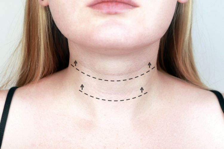 non-surgical neck tightening mclean