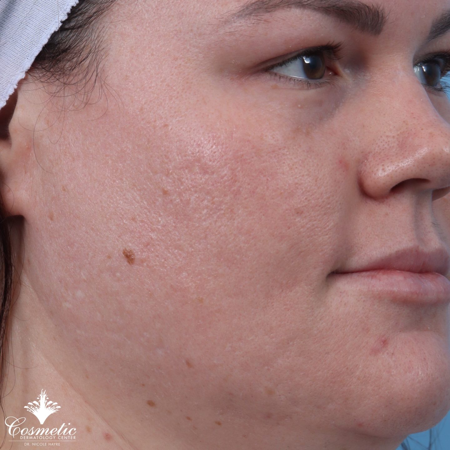 RF microneedling patient after treatment