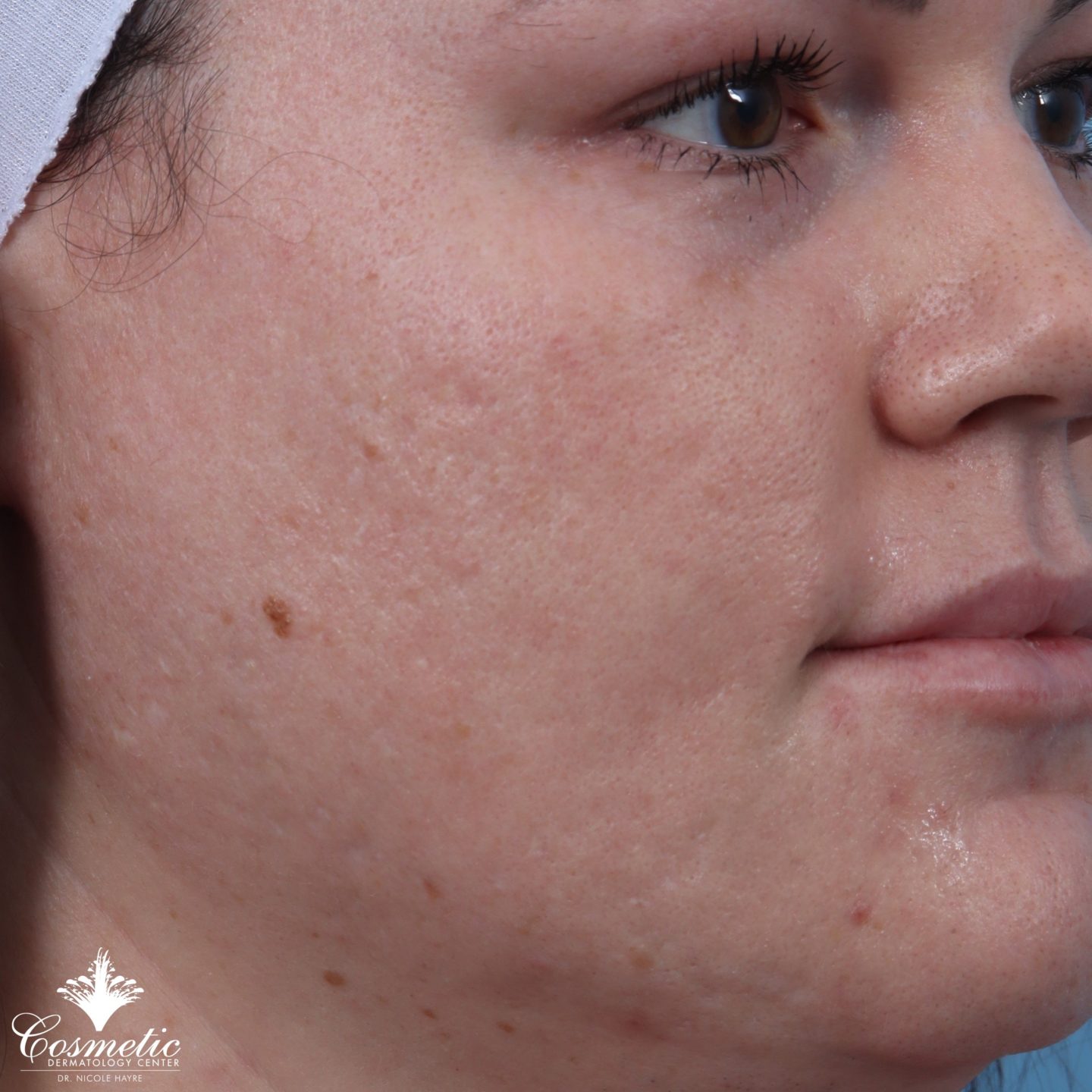 RF microneedling patient before treatment
