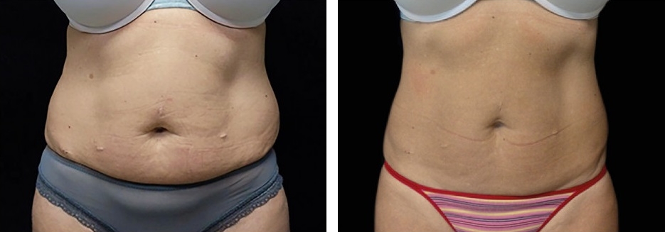 emsculpt before and after abs