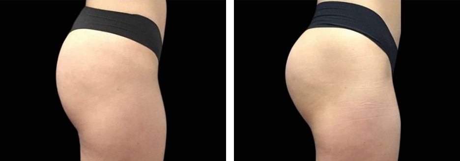 emsculpt before and after butt