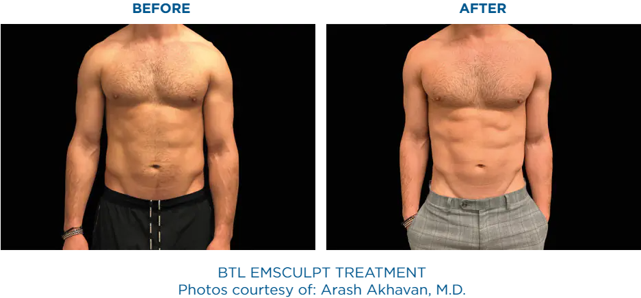 emsculpt before and after abs