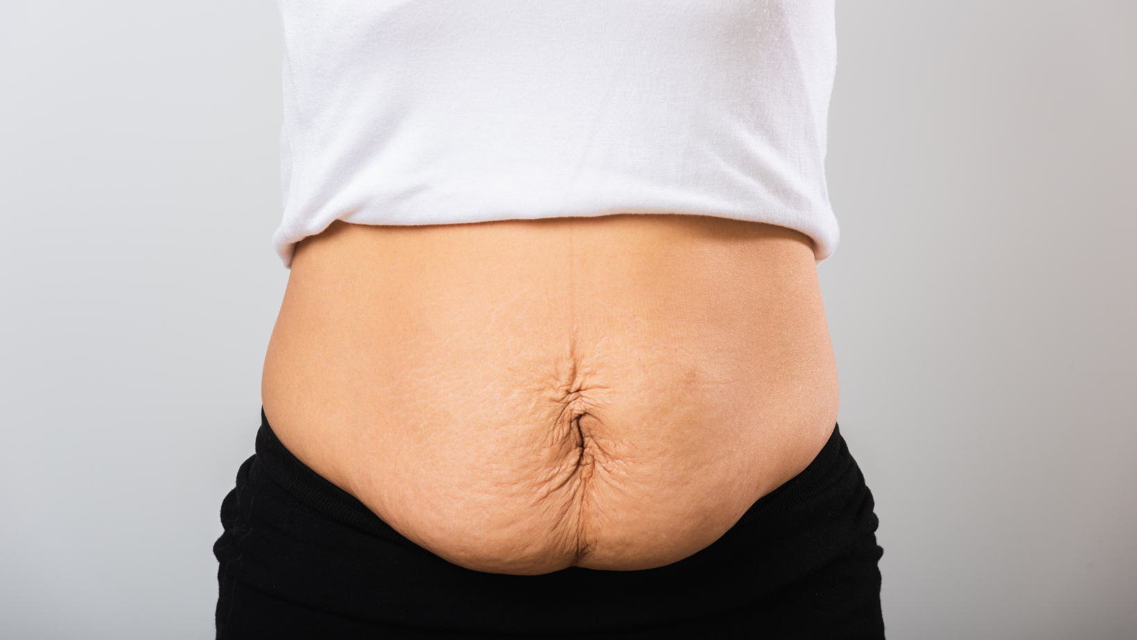 Mommy Tummy” – Evidence-Based Techniques for Treatment and